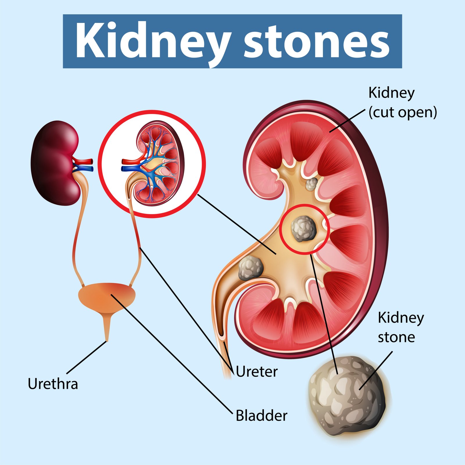 Kidney, Ureteric & Bladder Stones